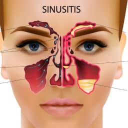 Sinus infection illustration